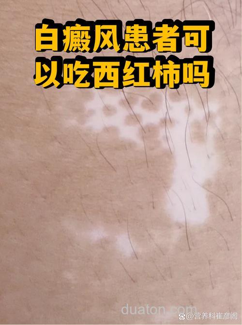 听说有白癜风的人不能吃西红柿?为什么呢?那鱼能吃吗?